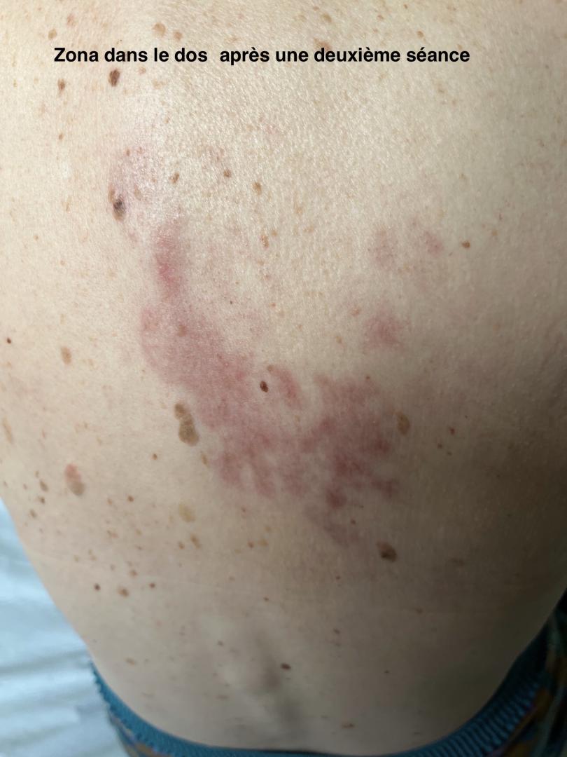 Zonados après une deuxième séance
